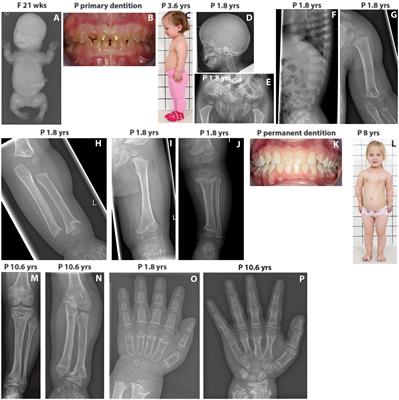 Oligogenic Inheritance of Monoallelic TRIP11, FKBP10, NEK1, TBX5, and NBAS Variants Leading to a Phenotype Similar to Odontochondrodysplasia